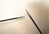 LapStick suture